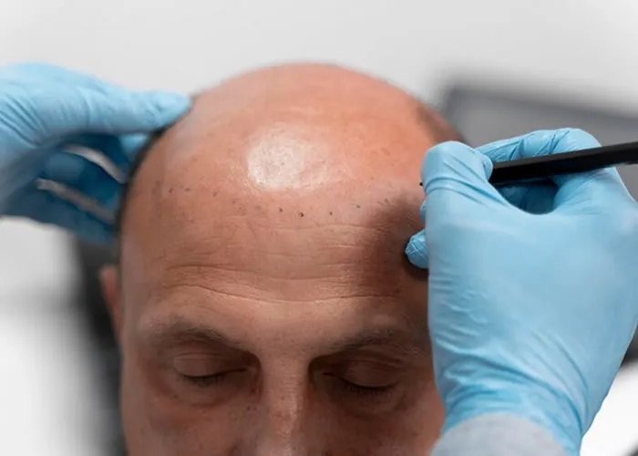 O cabelo é parte integrante da nossa aparência. Temos cabelos para expressão, comunicação e defesa únicas. Todo mundo tem uma maneira única de pentear o cabelo. A cor do cabelo é uma maneira simples de se expressar. Existem muitos tipos de cabelo; todos têm texturas, cores e estruturas de cabelo únicas. Nosso cabelo é uma parte vital de nossa vida.

A perda de cabelo é um problema comum que afeta muitas pessoas. Homens e mulheres experimentam a perda de cabelo de maneira diferente. Todo mundo experimenta diferentes formas de queda de cabelo, alopecia e calvície. A cirurgia de restauração capilar é feita quando você perde cabelo suficiente para torná-lo perceptível. Os pacientes que querem cabelos na cabeça costumam escolher essa opção. Algumas pessoas optam por fazer uma restauração de mini-cabelo quando começam a perder cabelo. Isso permite que eles tenham uma pequena quantidade de cabelo novo antes da cirurgia. Pacientes que querem cabelos grossos geralmente escolhem essa opção também. Cabelos grossos e saudáveis são importantes para uma boa aparência e saúde.

A cirurgia de transplante capilar tornou-se muito mais segura nos últimos anos. Cirurgias anteriores tinham complicações perigosas que podiam deixar os pacientes desfigurados por toda a vida. Os médicos realizaram a cirurgia removendo pequenas seções de cabelo de diferentes partes do couro cabeludo. Eles então misturariam essas seções para fazer um novo transplante. Isso foi feito sem qualquer técnica de anestesia ou esterilização. Agora, os médicos realizam a cirurgia usando anestesia local e equipamentos estéreis para limitar os riscos de infecção. Os transplantes de cabelo são agora muito mais seguros do que costumavam ser.

Muitos pacientes optam realizar suas cirurgias de restauração capilar. Cirurgião de restauração capilar que fez muitos transplantes para calvície masculina e outras condições. 

A cirurgia de restauração capilar é uma excelente maneira de restaurar cabelos perdidos ou danificados. Os pacientes que querem cabelos na cabeça geralmente escolhem essa opção, mas é uma ótima opção para quem quer mudar o penteado ou a aparência! Os transplantes capilares são agora muito mais seguros graças à tecnologia atualizada e à experiência de cirurgiões renomados.

, Tratamento capilar, Capiar FUE Fio a Fio e Remedios para Calvicie, em, Brasil