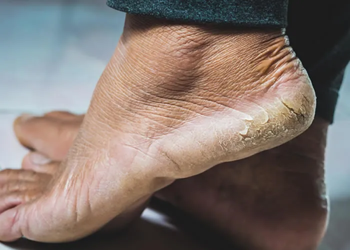 Não apenas o rosto, mas todo o corpo fica seco no tempo frio. No inverno, as pessoas também ficam muito incomodadas com calcanhares rachados, principalmente as mulheres. Algumas pessoas começam a sangrar nos tornozelos. Em que muita dor também começa. Em tal situação, você deve adotar alguns remédios caseiros, pois eles eliminarão esse problema pela raiz. 
Então vamos conhecer essas dicas.

Se você quiser se livrar de seus calcanhares rachados, esfregar é muito importante. Para isso você pode usar açúcar, mel e limão. Isso removerá as células mortas dos calcanhares.

A cera também é muito eficaz para se livrar de calcanhares rachados. Misture duas gotas de óleo e use meias à noite, depois limpe pela manhã, com isso, seus calcanhares rasgados começarão a cicatrizar lentamente.

A farinha de arroz também é eficaz para aliviar os calcanhares rachados. Você deve pegar 2 colheres de farinha de arroz e massagear bem aplicando 1 colher de mel, 3 a 4 gotas de vinagre de maçã e azeite ou óleo de coco.

A vaselina também é eficaz para se livrar de calcanhares rachados. Tudo o que você precisa fazer é aplicá-lo antes de dormir. Com isso, você começará a obter alívio em breve.

Além disso, para se livrar dos calcanhares rachados, sente-se com os pés em água morna, depois esfregue os calcanhares com pedra-pomes e limpe-os, depois aqueça óleo de amêndoa ou óleo de coco e aplique nos calcanhares

, Cera para o corpo, Cuidados com os pés e NIVEA Beleza Radiante, em, Brasil