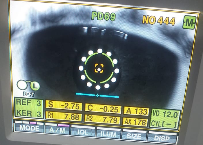 Exame de vista, Você sabia que um exame optométrico pode detectar sinais iniciais de doenças graves como os tumores de cabeça e pescoço? A clínica Opto Prime, durante a campanha Julho Verde, tem intensificado seus esforços de educação, triagem e encaminhamentos precoces. A avaliação visual vai muito além de medir grau: é um momento de escuta, observação clínica e orientação. Muitos pacientes chegam por simples queixas visuais e saem com encaminhamentos que podem salvar suas vidas. A saúde visual é parte essencial da saúde geral. Valorize sua visão, cuide-se e participe das campanhas de prevenção.


Durante o Julho Verde, mês de conscientização sobre os tumores de cabeça e pescoço, é essencial lembrar que a saúde visual também pode ser impactada por essas doenças. Tumores localizados na região ocular, órbitas, cavidade nasal e seios paranasais podem gerar sintomas como visão dupla, perda parcial da visão e dores ao redor dos olhos. A atuação do optometrista é crucial na detecção precoce dessas alterações, colaborando com outros profissionais da saúde para diagnósticos mais rápidos. A clínica Opto Prime realiza avaliações optométricas completas, que podem sinalizar alterações estruturais visuais compatíveis com essas doenças. Quanto mais cedo forem identificadas, maiores as chances de tratamento eficaz. 

#JulhoVerde #OptometriaPreventiva #SaúdeVisual #OptoPrime, Optometria preventiva, Márcia Sousa Optometrista, em, Educador Social 60+