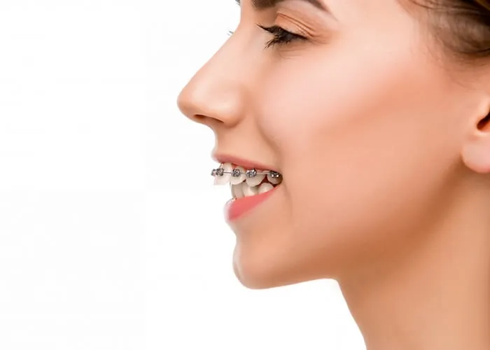 Gente, quem usa aparelho ortodôntico precisa ter um cuidado a mais com a higiene bucal no dia a dia, né? E o bom é que dá pra contar com acessórios, como a escova interdental, que fazem toda a diferença pra uma limpeza completa dos dentes. 

Quer pegar algumas dicas de como cuidar dos dentes com aparelho? Vem comigo que eu te mostro!


Escove os dentes depois das refeições - Olha, como o aparelho dentário pode acumular mais restos de comida na boca, o ideal é fazer a escovação todas as vezes depois que comer, mesmo que seja uma fruta!

É fundamental escovar os dentes com movimentos delicados por cima do aparelho


Escovas de dente - Vale a pena ter uma boa escova de dentes, como os modelos elétricos, e usar também a escova interdental. Ela é feita com cerdas bem fininhas e que se encaixam certinho nos espaços entre os dentes e o aparelho!

A escova interdental é feita de cerdas de nylon bem macias e flexíveis


Irrigador oral - Outro acessório que ajuda bastante é o irrigador oral. Ele solta jatinhos de água que conseguem tirar até as sujeirinhas mais difíceis! Invista ainda num bico pra irrigador oral ortodôntico, que vem com formato pra limpar direitinho a língua, gengivas e os cantinhos do aparelho.

Esse irrigador oral ainda massageia a gengiva pra aliviar a pressão do aparelho


Enxaguante bucal - Depois, o antisséptico ou enxaguante bucal é ótimo pra eliminar os últimos germes e bactérias que às vezes ficam na boca mesmo depois da escovação!

Esse enxaguante bucal pode ser usado em bochechos de 30 segundos


De olho na manutenção da higiene bucal


Pra uma higiene bucal em dia, principalmente durante o uso do aparelho, é importante tomar cuidados como:


- Evite mascar chicletes e ingerir pirulitos e balas. Se eles grudam nos dentes ou no aparelho, é um pouco mais difícil de tirar em casa.
- Deixe de lado alimentos mais duros, grudentos ou gordurosos, pois podem quebrar o aparelho e os dentes!
- Tente não beber refrigerantes e cafés, que geralmente mancham os dentes com mais facilidade quando tão com aparelho!


Além desses cuidados, é fundamental fazer a manutenção do aparelho indo ao dentista ao menos de 3 em 3 meses, tá? Assim, o profissional vê se tá tudo direitinho, se precisa trocar alguma pecinha ou até mesmo fazer tratamento pra placas, cáries ou qualquer tipo de desconforto., Melhor aparelho dental , Aparelho ortodôntico e Implante dentário, em, Brasil