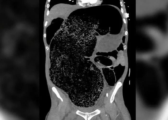 Radiografia mostra o acumulo de fezes no abdome do senhor.

Ele foi levado ao hospital, onde os médicos descobriram que suas pernas estavam dormentes e frias. Eles decidiram fazer um raio-x para tentar um diagnóstico e o que apareceu foi que uma grande massa de fezes estava se acumulando nos intestinos. O paciente havia desenvolvido síndrome compartimental abdominal (SCA), os órgãos internos estavam com uma pressão interna muito maior do que o normal, causando muita dor e paralisia. A artéria que abastece as extremidades inferiores foi pressionada e as pernas não receberam o sangue de que precisavam.

Além da paralisia das pernas, o excesso de fezes também prejudicava os rins devido à alta pressão no abdômen. A saída tinha que ser a cirurgia, já que o bolo fecal não podia mais sair naturalmente. No total, foram retirados 2 litros de fezes. Demorou 4 dias na UTI e mais 13 dias de recuperação para voltar a andar. Os médicos calcularam que o paciente não tinha evacuado por pelo menos um mês., Assistência Médico-Hospitalar, Melhores receitas e Ebook saúde e vida , em, Brasil