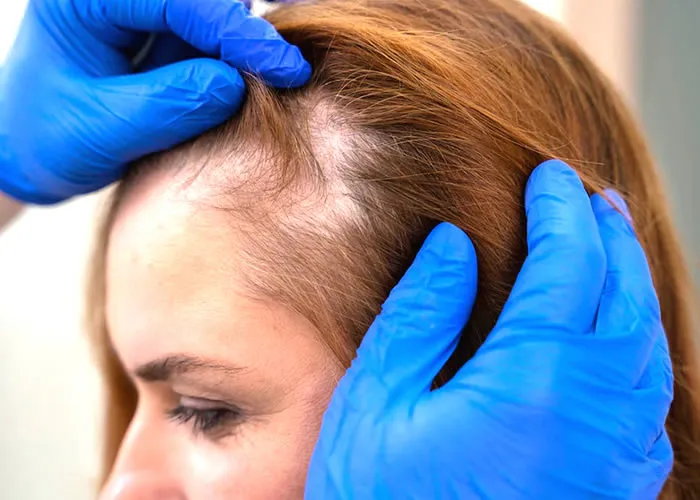 O cabelo é um componente importante do corpo humano. O cabelo serve a muitos propósitos, como regulação térmica e proteção. Muitas criaturas não têm cabelo, mas os humanos desenvolveram um sentimento de orgulho em seus cabelos. Algumas pessoas têm cabelos naturalmente loiros ou morenos, enquanto outras têm cabelos pretos. 

O cabelo desempenha um papel importante no desenvolvimento humano, portanto, manter o cabelo saudável é essencial. Muitas mulheres muitas vezes perdem cabelo durante a vida. A perda de cabelo afeta mais as mulheres do que os homens devido à presença de mais células da pele. As mulheres podem experimentar ainda vários distúrbios de pele, como psoríase ou eczema. No entanto, a perda de cabelo é muito mais prevalente em mulheres do que em homens. As mulheres são mais propensas a experimentar alopecia, com o estresse exacerbando a condição. Outras mulheres geralmente perdem o cabelo em circunstâncias normais. No entanto, fatores anormais também podem contribuir para a queda de cabelo feminino.

As mulheres experimentam maior perda de cabelo do que os homens devido à sua maior área de pele. Quase metade das mulheres tem algum grau de alopecia aos trinta anos. Também podem perder o cabelo devido ao estresse. A ocorrência de queda de cabelo feminina é diretamente proporcional à gravidade da condição da pessoa.

Mamíferos fêmeas também podem perder o cabelo devido a certas doenças ou parasitas. Os vermes fêmeas comumente habitam as glândulas sebáceas, resultando em condições malignas que afetam as glândulas sebáceas e os folículos. 

As mulheres que se recuperam de condições malignas que afetam as glândulas sebáceas mais rapidamente do que os homens. Algumas condições que afetam mais mulheres do que homens, resultando em maior perda de cabelo feminino.

O cabelo cai com frequência durante períodos de estresse prolongado para humanos e outros animais. O medo e o estresse severos resultam em maior perda de cabelo do que o normal para mulheres e animais jovens.
 
Certas situações contribuem para o aumento do estresse nas mulheres,  estes incluem gravidez, perda de peso e menopausa, entre outros. Medo severo ou lesão física também podem desencadear aumento da perda de cabelo entre as mulheres. As mulheres podem se recuperar de longos períodos de estresse melhor do que os homens devido a diferentes estruturas corporais e hormônios.
 
Os humanos se recuperam mais rapidamente de traumas físicos ou emocionais do que os machos devido à presença de mais células da pele e receptores de estrogênio. Medo extremo ou danos físicos podem resultar em maior alopecia feminina após estresse prolongado.

A maioria das mulheres acha a calvície masculina perturbadora porque associam sua aparência com juventude e autoconfiança. No entanto, a calvície masculina não tem correlação com a idade ou autoconfiança. A condição é puramente genética e ocorre principalmente no couro cabeludo dos homens à medida que envelhecem. Embora geralmente resulte em um crescimento mais fino do cabelo no couro cabeludo, a calvície masculina não significa necessariamente sérios problemas de saúde, como a calvície feminina faz para as mulheres. Portanto, se alguém próximo a você tem calvície masculina, você pode se sentir menos chateado com isso, pois não afeta sua aparência tanto quanto a calvície feminina afeta as mulheres.

Fatores emocionais contribuem para o cabelo feminino em todo o seu vida,  assim como para os homens. O cabelo desempenha um papel importante no desenvolvimento humano,  portanto, manter o cabelo saudável é essencial para homens e mulheres. 

Muitos fatores contribuem para o cabelo feminino ao longo da vida,  incluindo estresse prolongado, condições malignas e fatores genéticos, assim como para os homens. Por esta razão, não existe uma abordagem padrão ao tentar tratar os pelos femininos ao longo da vida, pois cada mulher é única à sua maneira e reage de maneira diferente a esses distúrbios.

, Tratamento capilar feminino, Hidratar os Cabelos Ressecados e Tratamento de L´Oreal, em, Brasil