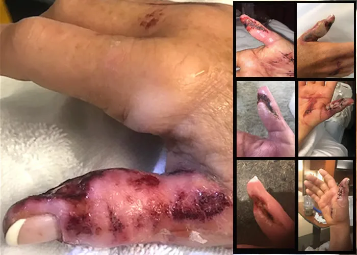 Na hora só foi um cortezinho, ela disse "perdão coração, tirei um bifezinho do seu dedo!", eu disse tudo bem da doendo não. Após concluir meu atendimento fui pra casa e não dei muita atenção, mas depois de duas horas começou a latejar, a noite sentir formigar minha mãe e as dores começaram a se alastrar  pelo meu braço, fui quando procurei um hospital, quase perdi meu dedo! 

No dia posterior ainda sentir muitas dores fiz o uso de Pomadas cicatrizantes e sabonetes antibacterianos que logo usei logo após o ocorrido , use sempre um antibacteriano e cremes para cicatrizar. Faça o uso de sabonetes diário para afastar qualquer tipo de infecção. 

Os salões de beleza oferecem penteados e manicures sem a inconveniência de uma ida a um salão de beleza regular. Ocupando apenas alguns quartos em alguns estabelecimentos, os salões de manicures e pedicures  oferecem tanto para mulheres quanto para homens um lugar para fazer as unhas.

As ferramentas e equipamentos especializados empregados nesses estabelecimentos os tornam muito diferentes dos salões de beleza normais. Aqui estão algumas das coisas que  as profissionais de unhas fazem por seus clientes.

Dê bastante atenção para a evolução da inflação para que não ocorra amputação do dedo afetado, a dor é grande.

Primeiro, a maioria das profissionais de unhas mantém bastante água à mão para que seus clientes possam lavar as mãos antes e depois de seus compromissos. Eles também mantêm sabão e soluções desinfetantes à mão para esses fins. As técnicos de unhas também aconselham os clientes sobre como manter as mãos limpas, não é incomum que eles próprios mesmo lavem as unhas de seus clientes. Para prevenir infecções, eles também usam desinfetantes nas superfícies em que trabalham.
 
Clientes às vezes preferem usar suprimentos que trouxeram com elas. Por exemplo, elas podem querer pintar ou decorar as unhas de seus clientes com seus próprios materiais. Alternativamente, elas podem querer consertar unhas quebradas ou rasgadas antes de aparar e moldar novas. 

É melhor que as estilistas avisem seus clientes se eles terão algum problema com as mãos antes de iniciar o trabalho. Por exemplo, alguns estilistas acham que a pele seca em suas mãos causa problemas ao trabalhar em unhas molhadas, então eles trazem hidratante por esse motivo.

Além das medidas de segurança e soluções desinfetantes ajudam a evitar a propagação de germes nocivos. A maioria das soluções desinfetantes mata bactérias, vírus e germes que causam infecções e outros problemas de saúde. Além disso, as soluções desinfetantes evitam o crescimento de fungos nocivos que tendem a crescer nas unhas das pessoas depois de fazê-las. Como os salões de manicure costumam ter mais de uma cliente por vez, é importante que essas soluções sejam aplicadas e mantidas de forma consistente em todo o espaço.

Devido aos riscos associados à realização de unhas em espaços públicos, muitas pessoas preferem feitas em casa ou em estúdios de unhas especializados. No entanto, certos riscos se apresentam ao fazer unhas em locais como empresas ou faculdades de beleza. Portanto, é melhor planejar seus compromissos com antecedência para ter certeza de que seus dedos estarão seguros enquanto você estará ficando fabulosa!

, Salão de beleza profissional, Curso de unha em gel e Tecnologia unhas em gel, em, Brasil