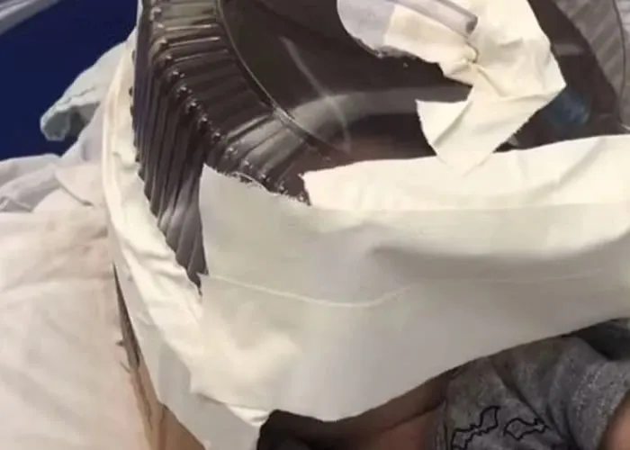 Bebê que usou capacete de oxigênio improvisado com embalagem de bolo recebe alta da UTI e emociona equipe médica com recuperação surpreendente.

A criança ainda não foi liberada para voltar para casa porque necessita de suplementação de oxigênio através de um cateter nasal.

A história do bebê, que tem hidrocefalia e síndrome de Dandy-Walker, ganhou notoriedade nacional após ser levado ao Hospital Municipal de Santa Cruz no último sábado (8).

Devido à gravidade do quadro, ele precisou aguardar até segunda-feira (11) para ser transferido. Durante esse período, a equipe do hospital improvisou uma máscara de oxigênio usando uma embalagem de bolo para atender à urgência da situação.

A máscara improvisada foi utilizada por cerca de quatro horas, até que materiais adequados, emprestados de outro hospital, chegaram para proporcionar o atendimento necessário., Suplementação, Carrinho bebê e Cadeirinha Bebê, em, Brasil