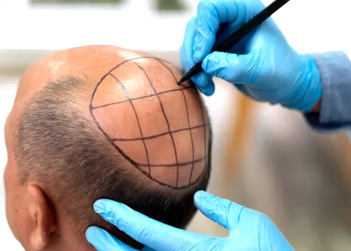 A extração da unidade folicular ou FUE é uma técnica de transplante capilar que remove o cabelo da bainha radicular externa do folículo piloso. Esta técnica separa os folículos capilares das raízes e permite o crescimento de novos cabelos. A extração folicular é uma técnica minimamente invasiva que requer o mínimo de anestesia e apresenta menos complicações. Também é menos doloroso do que a cirurgia aberta e causa menos perda de sangue. 

O FUE tem várias vantagens, como tempo de inatividade mínimo, cicatrizes mínimas, perda mínima de cabelo e nenhum risco de formação de tumor.

O processo de extração FUE consiste em três etapas - aparar, incisar e extrair. Na primeira etapa, o cabelo é cortado acima da papila dérmica. Na segunda etapa, a derme é aberta e o folículo é extraído com uma agulha. Depois disso, a abertura é fechada com suturas ou grampos e a umidade é aplicada para promover o crescimento de novos fios. Finalmente, após quatro a seis semanas, novos cabelos começarão a aparecer em seu couro cabeludo.

FUE é um tratamento econômico para a calvície porque não requer uma grande incisão ou um período de recuperação prolongado. Como a anestesia anêmica mínima é usada neste tratamento, as pessoas submetidas à FUC podem trabalhar durante a cirurgia sem se preocupar com problemas de desempenho. 

Além disso, não há complicações associadas à anestesia geral; os pacientes podem acordar sem problemas ou complicações. Além disso, o tempo de recuperação após a cirurgia também é muito rápido, pois são necessários cuidados mínimos com a ferida após a cirurgia. Os pacientes geralmente podem retornar ao seu horário normal dentro de três dias após a cirurgia.
Existem várias clínicas que oferecem extração de unidade folicular (FUE) para homens na China, Índia, Paquistão e Turquia. Por exemplo, na Índia existem 18 clínicas que realizam FUE para homens todos os anos. As pessoas que vivem nesses países têm mais opções quando se trata de tratar a calvície via FUE. Há também uma associação para FUE nesses países chamada FFUELAB que promove pesquisas neste campo e fornece educação para médicos de todo o mundo sobre como realizar este método de tratamento de forma eficaz e segura.

A extração de unidade folicular ou FUE é um procedimento minimamente técnica invasiva que substitui o cabelo perdido por um novo crescimento de cabelo.

O FUE é um tratamento econômico para a calvície porque não requer uma grande incisão ou um período de recuperação prolongado. Existem várias opções de tratamento disponíveis para homens que vivem na Índia e na China, onde este método de tratamento é popular entre os pacientes que vivem com condições de alopecia/calvície., Tricologia capilar, Tratamento a laser calvice e Clinica calvice, em, Brasil