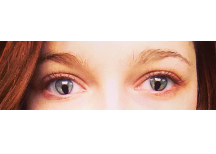Exame de vista OptoPrime, O coloboma é uma condição ocular causada por uma falha no fechamento da fissura embrionária durante as primeiras semanas de gestação. Essa fissura é essencial para o desenvolvimento normal dos olhos. Quando o processo de fechamento não é completo, pode surgir uma abertura em partes do olho, como a íris, pálpebra, retina, coróide ou nervo óptico. Alterações na íris ou na pálpebra geralmente não afetam a visão, mas se a falha ocorrer na retina ou no nervo óptico, há risco significativo de perda visual ou cegueira.

Uma malformação ocular congênita que pode afetar diferentes estruturas do olho, como a íris, a retina, o nervo óptico e a coroide. Essa condição está presente desde o nascimento e pode provocar redução significativa da acuidade visual, sensibilidade à luz e alterações no campo de visão. Embora seja uma alteração rara, o coloboma exige atenção cuidadosa e acompanhamento contínuo, especialmente quando identificado na infância.

Nesse contexto, o papel da optometria na atenção primária à saúde visual é essencial para a detecção precoce, o encaminhamento e o monitoramento desses casos. A atuação de profissionais como Márcia Sousa e Gleydson Forlan, optometristas da OptoPrime, representa um avanço importante no cuidado visual centrado no paciente, com foco na prevenção e na funcionalidade da visão.

O exame de vista OptoPrime inclui uma análise detalhada da anatomia e da função visual, com ênfase em condições como o coloboma, que muitas vezes passam despercebidas em exames convencionais. O optometrista avalia a integridade da pupila, observa deformações na íris e identifica sinais compatíveis com colobomas em exames de fundoscopia funcional. Essa atenção permite a intervenção precoce e melhora a qualidade de vida, principalmente em crianças em idade escolar.

Além disso, os optometristas orientam pacientes e familiares sobre adaptações no ambiente, proteção contra luz intensa, uso de óculos com filtro e estratégias para ampliar o desempenho visual. A abordagem optométrica não apenas detecta a condição, mas também propõe caminhos acessíveis e eficazes para que o paciente viva com maior conforto e segurança., Exame de Vista, Optoprime Manaus, em, Óptica e Optometria