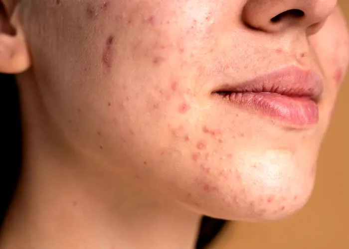 Veja vários tratamentos de pele flácida para mulheres que enfrentam a flacidez, alergias e preocupações relacionadas à idade.

Experimente o efeito transformador com  cosméticos antienvelhecimento altamente eficazes por especialistas em cosméticos.

A Importância dos Cuidados com a Pele na Prevenção do Câncer de Pele e Efeitos do Envelhecimento.

Tratamento especializado é o único, seguro e confiável que trata com sucesso marcas de de rugas de pele inferior e celulite.

A  hiperpigmentação com alergias pode ser um problema de pele comum,  é uma adaptação natural do corpo em resposta ao estresse na pele.
 
Geralmente acontece na forma de descoloração, cicatrizes de acne ou inchaços e é comum com mudanças na estação.

Como as alergias geralmente se manifestam como um problema de pele?

Você começa a coçar instantaneamente quando seu produto para a pele tem alguns ingredientes que fazem você reagir?

Você tem urticária, eczema ou manchas secas ao redor da área irritada?

Se algum deles aparece em você, é hora de consultar seu dermatologista para desenvolver um tratamento de que resolva esse problema.

, Tratamento pele rosto, Hidratantes corporais e Melasma e Dermatites, em, Brasil