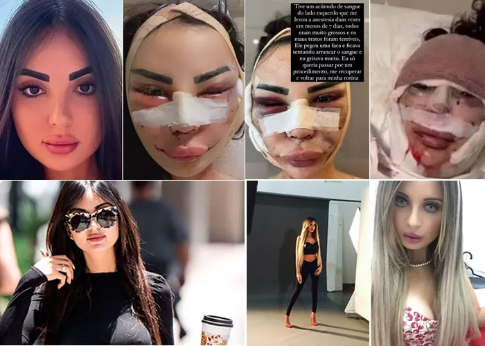 A atriz e modelo brasileira Jennifer Pamplona, de 29 anos, denuncia que foi vítima de violência cirúrgica em Istambul, na Turquia. Em seu Instagram, ela compartilhou uma série de fotos que mostram seu rosto inchado e cheio de machucados após os procedimentos estéticos. As imagens são fortes.

Em entrevista ao “UOL”, a modelo, que já admitiu ser viciada em cirurgias plásticas, tendo feito mais de 30 procedimentos, contou que estava na Turquia para fazer uma campanha, quando decidiu procurar um especialista para fazer uma série de mudanças no rosto. Ele é conhecido no meio dos famosos como “Hollywood Makeover”.

“Eram cinco procedimentos de uma vez. Eu não estava me sentindo bem e queria mudar”, iniciou a brasileira ao comentar sobre o caso. “Foi um verdadeiro filme de terror. Fiz a cirurgia e sofri diversos maus-tratos no hospital. Gritava de dor, pedia para eles me limparem, darem remédios e implorava por comida”, contou ela.

No Instagram, ela continuou explicando sobre os procedimentos: “Há poucos dias, minha vida se tornou um pesadelo que eu nunca imaginei viver. Fui maltratada no hospital onde fiz a cirurgia, fui maltratada pelo médico. Tive problemas após a cirurgia, que quase me levou à morte. Eu implorava pelo remédio para dor e para eles virem me limpar.”

“Tive um acúmulo de sangue do lado esquerdo que me levou a anestesia duas vezes em menos de 7 dias, todos eram muito grossos e os maus-tratos foram terríveis. Ele pegou uma faca e ficava tentando arrancar o sangue e eu gritava muito. Eu só queria passar por um procedimento, me recuperar e voltar para minha rotina”, disse a modelo.

Ela continuou relatando os momentos difíceis que enfrentou durante a cirurgia: “Tinha uma piscina de sangue no médico, que pegou uma faca enquanto tentava cortar meu rosto para tirar o sangue sem anestesia. Eu apenas queria que a cirurgia terminasse, queria voltar à minha rotina, mas se tornou um pesadelo que nunca imaginei viver na minha vida”, relatou Jennifer.

“Ele pegou meu sangue e depois colocou dentro de mim novamente sem me informar, muito grosso que perfurou minha veia com muita força. Vivi um pesadelo. Por isso que eu falo: pesquisem mil vezes antes de qualquer procedimento”, disse.

Ela destacou que sofreu muito com dores fortes e que não teve a devida assistência médica após a cirurgia. ”Não me limpavam nem me ajudavam a comer. Pedi ajuda várias vezes, chorei por morfina, porque só aguentava a dor com morfina”, disse ela, que continuou: “Meu rosto quase necrosou. Eu não tive nenhuma assistência e tive uma infecção. Lutei pela vida sozinha.”

Por fim, a modelo fez um alerta para que as pessoas tomem cuidado ao escolher um profissional para fazer qualquer cirurgia estética. “Eu faço um apelo às mulheres: esqueçam toda essa merda das Kardashians, elas fazem esses procedimentos e não mostram. Elas mentem o tempo todo e fingem ter uma vida perfeita. A vida não é perfeita”, afirmou.

A modelo, que mora em Dubai, nos Emirados Árabes, disse que ainda se recupera das lesões. Ela afirma que pretende relatar tudo o que passou em um documentário sobre o vício em cirurgias., Pós em estética, Centro de estética harmonização  e Clinicas de harmonização, em, Brasil