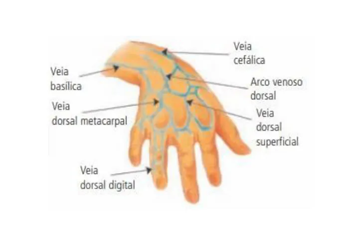 As veias metacarpais são um conjunto de veias localizadas na região dorsal (superior) da mão, sobre os ossos metacarpais. Elas correm ao longo da parte de trás da mão, conectando-se às veias superficiais e profundas da mão e do punho.

As veias metacarpais dorsais são frequentemente utilizadas para acessos venosos periféricos, como a inserção de cateteres intravenosos, conhecidos como Jelco. Essas veias são escolhidas devido à sua acessibilidade e facilidade de localização.

Ao realizar procedimentos que envolvem as veias metacarpais, é essencial seguir as práticas assépticas para prevenir infecções. A escolha da veia específica para acesso venoso dependerá da anatomia do paciente e da preferência do profissional de saúde.

Vale ressaltar que a utilização das veias metacarpais para acesso venoso pode variar dependendo das políticas e protocolos institucionais, bem como das condições clínicas do paciente. Sempre consulte as diretrizes locais e esteja ciente das considerações clínicas ao realizar procedimentos desse tipo.

As veias metacarpais geralmente não possuem nomes específicos individualizados, sendo referidas coletivamente como veias metacarpais dorsais. Elas são identificadas pela sua localização na região dorsal (superior) da mão, sobre os ossos metacarpais. A nomenclatura costuma ser mais genérica, descrevendo a região anatômica em que estão situadas. Portanto, ao realizar procedimentos como acesso venoso, o foco costuma ser na identificação e escolha das veias na região mencionada, sem referência a nomes específicos para cada uma delas.


Vamos conhecer o nome de cada uma anatomicamente,  seus prós e contras para administração de medicamentos no dorso da mão.



A veia basílica 



A veia basílica é uma das veias do antebraço e do braço humano. Ela faz parte do sistema venoso superficial e é uma das principais veias utilizadas para acesso venoso periférico. Aqui estão algumas características e informações sobre a veia basílica:

Localização

A veia basílica percorre ao longo da parte interna (medial) do braço e pode ser visualizada próximo à borda do braço.

Anatomia

A veia basílica geralmente se origina na região dorsal da mão, onde se forma a veia cefálica, e sobe pelo antebraço, percorrendo a parte interna do braço até se unir à veia cefálica para formar a veia axilar.

Acesso Venoso

Devido à sua trajetória e ao seu calibre, a veia basílica é frequentemente escolhida para procedimentos de acesso venoso, como a inserção de cateteres intravenosos. É comumente utilizada quando outras veias, como a veia cefálica, não são acessíveis ou não são apropriadas.

Técnica de Acesso

Ao realizar um acesso venoso na veia basílica, é importante seguir as práticas assépticas para prevenir infecções. A escolha da veia específica dependerá da anatomia do paciente e das condições clínicas. Após a inserção do cateter intravenoso, a veia basílica pode ser utilizada para administração de fluidos, medicamentos ou coleta de sangue.

Complicações

Como em qualquer procedimento médico, é essencial monitorar o paciente para possíveis complicações, como hematoma, infecção ou irritação local.

Lembrando que a anatomia vascular pode variar de pessoa para pessoa, e a escolha da veia para acesso venoso deve ser personalizada de acordo com as características individuais de cada paciente. Sempre é recomendado seguir os protocolos e diretrizes institucionais ao realizar procedimentos médicos.




As veias dorsais metacarpais




As veias dorsais metacarpais são um conjunto de veias localizadas na parte de trás (dorsal) da mão, sobre os ossos metacarpais. Essas veias correm ao longo da superfície dorsal da mão e estão conectadas às veias superficiais e profundas da mão e do pulso. 

Aqui estão algumas informações sobre a veia dorsal metacarpal.

Localização

As veias dorsais metacarpais estão situadas na região dorsal da mão, sobre os ossos metacarpais, que conectam os ossos do carpo aos ossos dos dedos.

Acesso Venoso

Essas veias são frequentemente utilizadas para acesso venoso periférico, como a inserção de cateteres intravenosos. Devido à sua localização acessível, elas podem ser escolhidas para procedimentos de coleta de sangue ou administração de medicamentos.

Técnica de Acesso

Ao realizar procedimentos que envolvem as veias dorsais metacarpais, é importante seguir as práticas assépticas para prevenir infecções. A escolha da veia específica dependerá da anatomia do paciente e da preferência do profissional de saúde.

Variação Anatômica

Como em qualquer sistema vascular, a anatomia das veias dorsais metacarpais pode variar de pessoa para pessoa. Algumas pessoas podem ter veias mais proeminentes e fáceis de acessar, enquanto outras podem requerer mais cuidado na identificação e punção.

Complicações

Monitorar o paciente para complicações potenciais, como hematoma, dor excessiva ou irritação local, é uma prática essencial ao realizar procedimentos que envolvem as veias dorsais metacarpais.

Lembrando que a escolha da veia para acesso venoso deve ser personalizada de acordo com as características individuais de cada paciente, e é importante seguir os protocolos e diretrizes institucionais ao realizar procedimentos médicos.





As veias dorsais digitais 




São pequenas veias localizadas na parte dorsal (superior) dos dedos. Elas são uma extensão das veias dorsais metacarpais e fazem parte do sistema venoso superficial da mão.

Aqui estão algumas informações sobre as veias dorsais digitais.

Localização

As veias dorsais digitais correm ao longo da parte de trás dos dedos, seguindo a estrutura dorsal dos mesmos.

Calibre e Anatomia

Essas veias são geralmente de calibre menor em comparação com as veias localizadas em áreas mais proximais da mão. Devido ao tamanho reduzido, são mais adequadas para procedimentos que envolvem punção de pequenos vasos.

Acesso Venoso

As veias dorsais digitais podem ser utilizadas para coleta de sangue ou inserção de cateteres intravenosos em situações específicas. No entanto, devido ao tamanho e delicadeza, o acesso venoso nessa região pode ser mais desafiador.

Procedimentos

Ao realizar procedimentos que envolvem as veias dorsais digitais, é essencial ser cauteloso e utilizar técnicas assépticas para evitar infecções.

Variação Anatômica

Assim como em outras partes do sistema venoso, a anatomia das veias dorsais digitais pode variar de pessoa para pessoa. Algumas pessoas podem ter veias mais visíveis e acessíveis, enquanto outras podem apresentar uma anatomia mais desafiadora.

Complicações

Como em qualquer procedimento médico, é importante monitorar o paciente para possíveis complicações, como hematoma, dor excessiva ou irritação local.

A escolha de usar as veias dorsais digitais para procedimentos venosos dependerá da necessidade clínica, da anatomia do paciente e das habilidades do profissional de saúde. Em alguns casos, a preferência pode recair sobre veias mais acessíveis em áreas adjacentes, como as veias dorsais metacarpais.


, Seguro de vida , Contrate Homecare e Profissional home care, em, Brasil