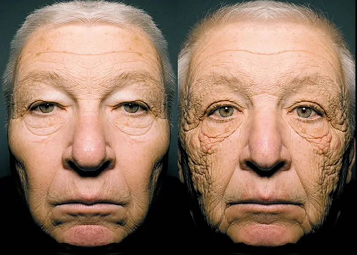 A imagem acima mostra o rosto de um caminhoneiro e foi amplamente compartilhada por jornais de todo o mundo justamente com a intenção de nos mostrar, na prática, o que os raios solares podem fazer com a pele humana.

No caso do caminhoneiro, percebemos que há uma grande diferença entre o lado direito e o lado esquerdo de seu rosto: o esquerdo simplesmente parece muito mais velho do que o direito. Isso aconteceu porque foi esse lado que ficou mais exposto ao longo dos últimos 28 anos, enquanto ele dirigia seu caminhão e tomava Sol na pele sem usar filtro solar.

Vale lembrar que se você suplementa com vitamina D, não se faz necessário ficar muito exposto ao Sol. Evite tomar Sol ao máximo e, com o suplemento de vitamina D é possível conseguir valores 3x maior em relação ao considerado "referência" para população. Estudo é abordado no "Protocolo Coimbra", onde doses de vitamina D são usadas para tratar pacientes com doenças autoimunes (Lupus, Miosite, Artrite, Diabetes, etc.).

, Adicione Addera D3, Imunidade e Saúde e Turbine sua Imunidade, em, Brasil