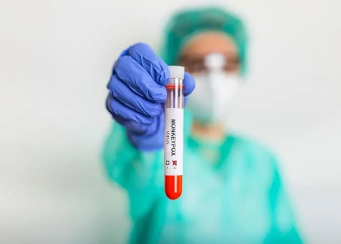 Varíola é uma doença infecciosa causada pelo vírus Variola, que foi erradicada globalmente em 1980, graças a um esforço de vacinação em massa e vigilância rigorosa. No entanto, ainda é relevante entender a doença, seus sintomas, tratamentos e causas, bem como o histórico de vacinação e medidas de cuidados.

Sintomas

Os sintomas da varíola incluem

Febre alta.
Mal-estar geral.
Dores de cabeça e nas costas.
Fadiga extrema.



Erupções cutâneas, que começam como manchas vermelhas que evoluem para pústulas, que são bolhas cheias de pus.

Tratamento

Não há tratamento específico para a varíola. O tratamento se concentra no alívio dos sintomas, como a administração de antipiréticos para febre e medidas para controlar a coceira nas erupções cutâneas. A principal medida preventiva é isolar o paciente para evitar a propagação da doença.

Causas

A varíola é causada pelo vírus Variola. Era transmitida de pessoa para pessoa por meio de gotículas respiratórias ou pelo contato direto com as lesões de pele do paciente.

Vacina

A vacina contra a varíola foi desenvolvida por Edward Jenner e se tornou a primeira vacina bem-sucedida na história da medicina. 

A vacinação em massa ajudou a erradicar a doença, e a varíola foi declarada erradicada em 1980., Biossegurança, Bolsa medicina e Bolsa de estudo , em, Brasil